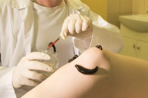 Что это такое гирудотерапия, когда и кому она нужна